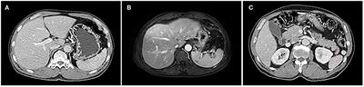 Challenge in Diagnosis and Treatment of Ectopic Hepatocellular Carcinoma: A Case Report and Literature Review